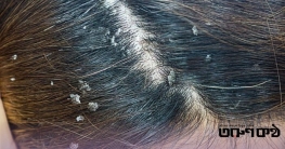 শীতে মাথার ত্বকে সোরিয়াসিস কেন হয়, লক্ষণ ও সমাধান কী শীতে মাথার ত্বকে সোরিয়াসিস কেন হয়, লক্ষণ ও সমাধান কী